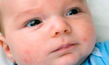 Аллергия в виде сыпи на коже у ребенка